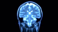 Fibromyalgia - Overview