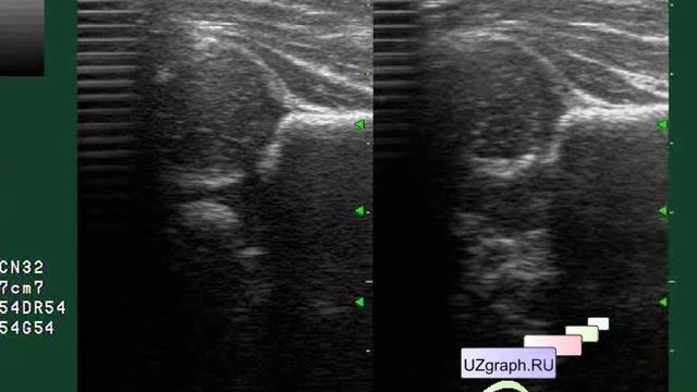 Лекция: УЗИ скрининг тазобедренных суставов у грудных детей. Базовый Уровень