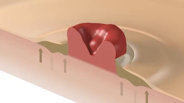 Защитное кольцо Brava моделируемое 2мм, арт 12030, Coloplast 2