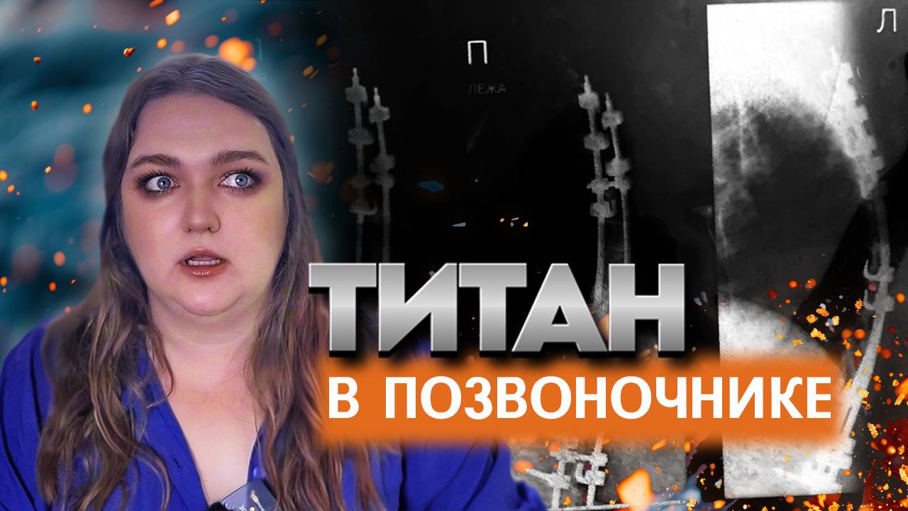 Жизнь с титановой конструкцией в позвоночнике. Моя история психотравмы