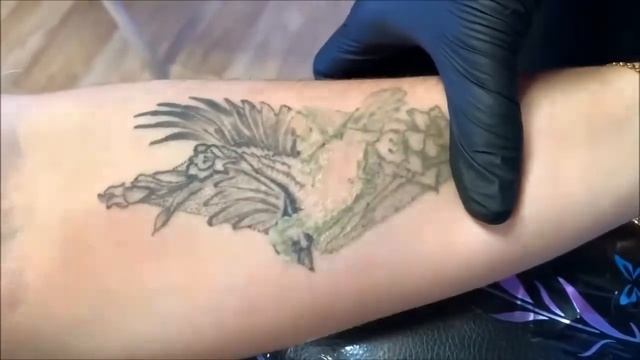 Удаление татуировки неодимовым лазером в Брянске  Без ожогов и рубцов