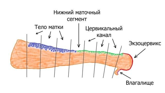 Вырезка матки 2 - рак эндометрия