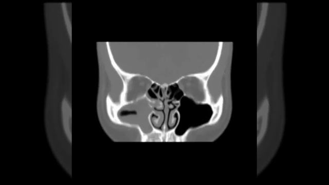 HN C9 Acute Sinusitis (B)