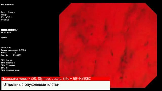 Клиническое наблюдение "Необычное наблюдение раннего рака желудка". С. С. Пирогов