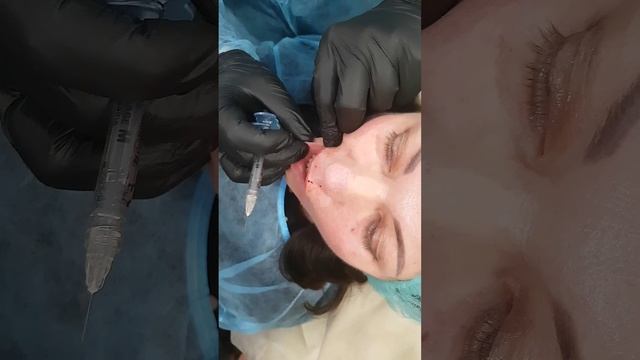 Убираем морщины марионетки.