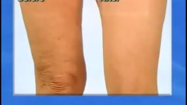 Лента Instant Arm Lift для нехирургической подтяжки кожи рук