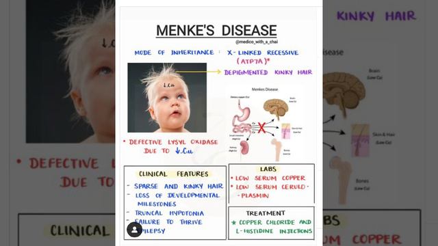 Болезнь Менкеса (Menke's Disease)!