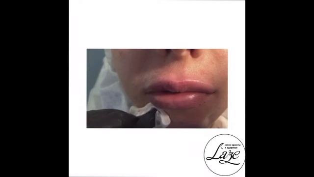 Контурная пластика губ