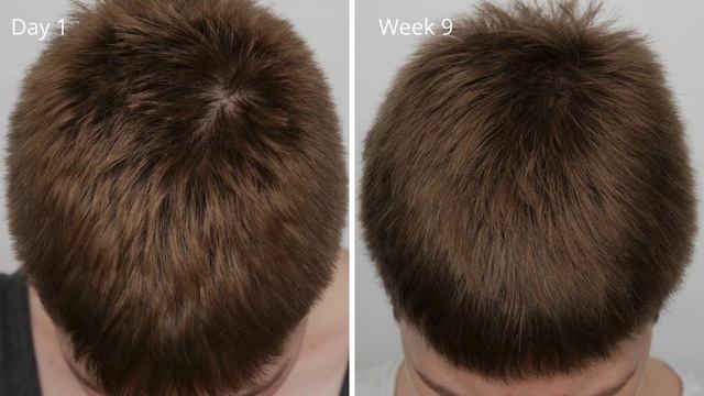 The Ordinary Hair Serum with La Roche Posay Kerium Extra Gentle Shampoo | 9 Weeks Results