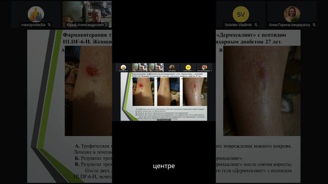 Биорегуляторный пептид VS Трофическая язва