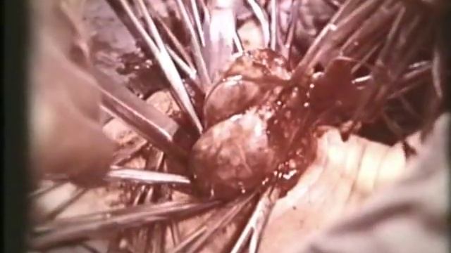Резекция зоба на шее © Resection of goiter on the neck