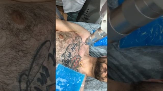 Удаление татуировки