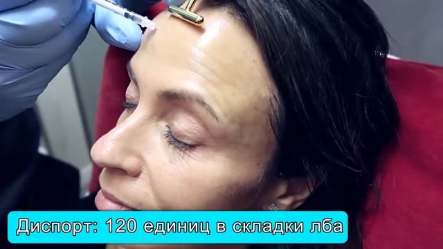 Диспорт в морщины лба