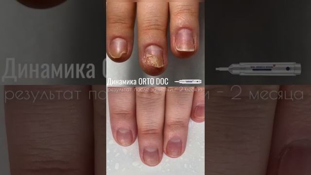 КАК ВЫЛЕЧИТЬ грибок, герпес, онихолизис, ногти.