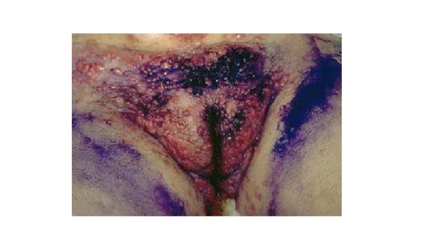 Blue waffles disease pictures in men and women