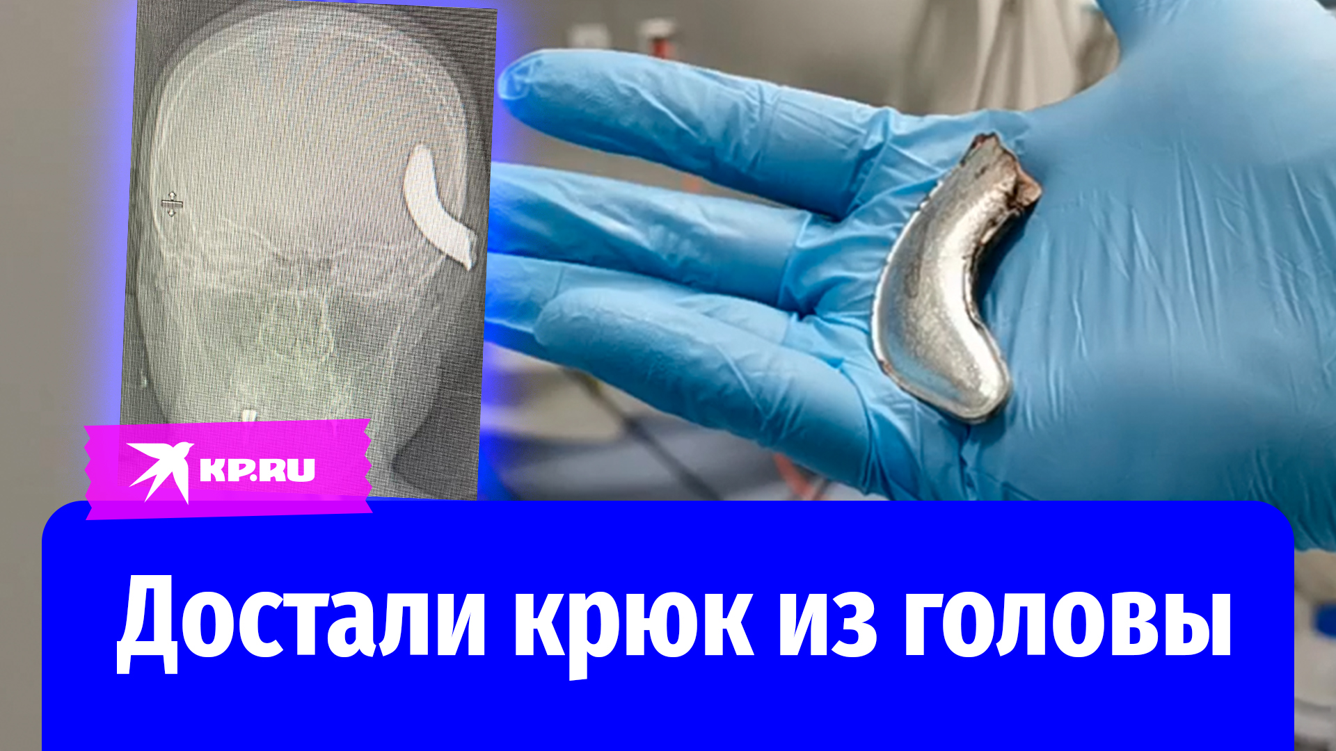 Нейрохирурги Санкт-Петербурга достали железный крюк из головы мужчины