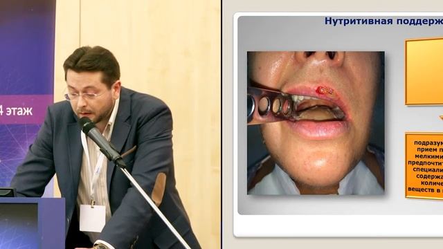 Нутритивная поддержка у больных с опухолями головы и шеи
