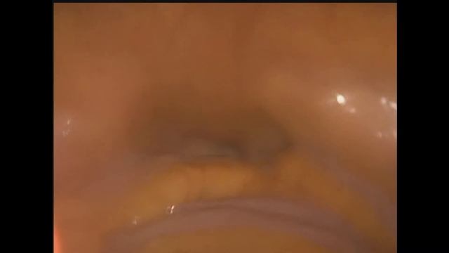 Лапароскопическое лечение  пролапса органов таза / Pelvic organ prolapse