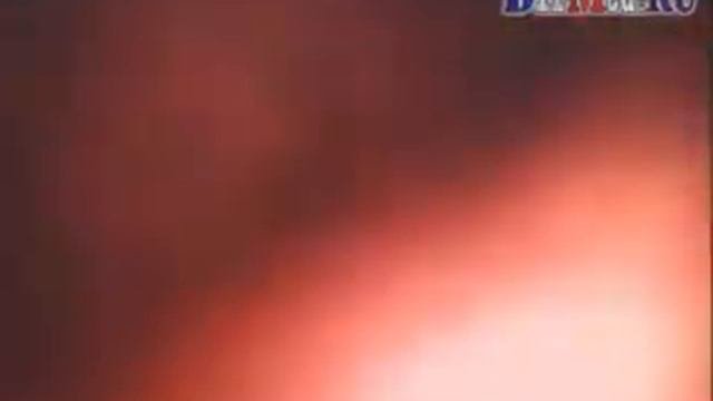 полип желудка  полипэктомия