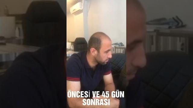 SAÇ ÇIKARAN LOSYON 45 GÜNLÜK KULLANIM ÖNCESİ VE SONRASI ?