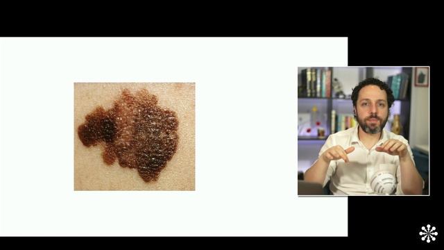 Melanoma e câncer de pele: Quais os critérios clínicos para saber se uma pinta é melanoma?