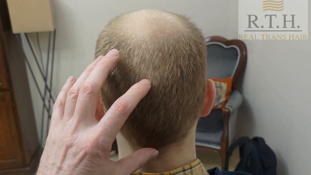 Как проходит пересадка волос если зона потери достаточно обширная - 5А?