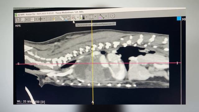 История Кузьмы с опухолью грудной полости
