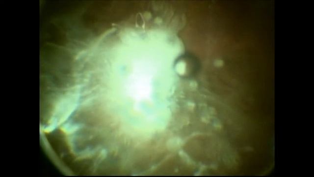 Intravitreal Kenalog Injection