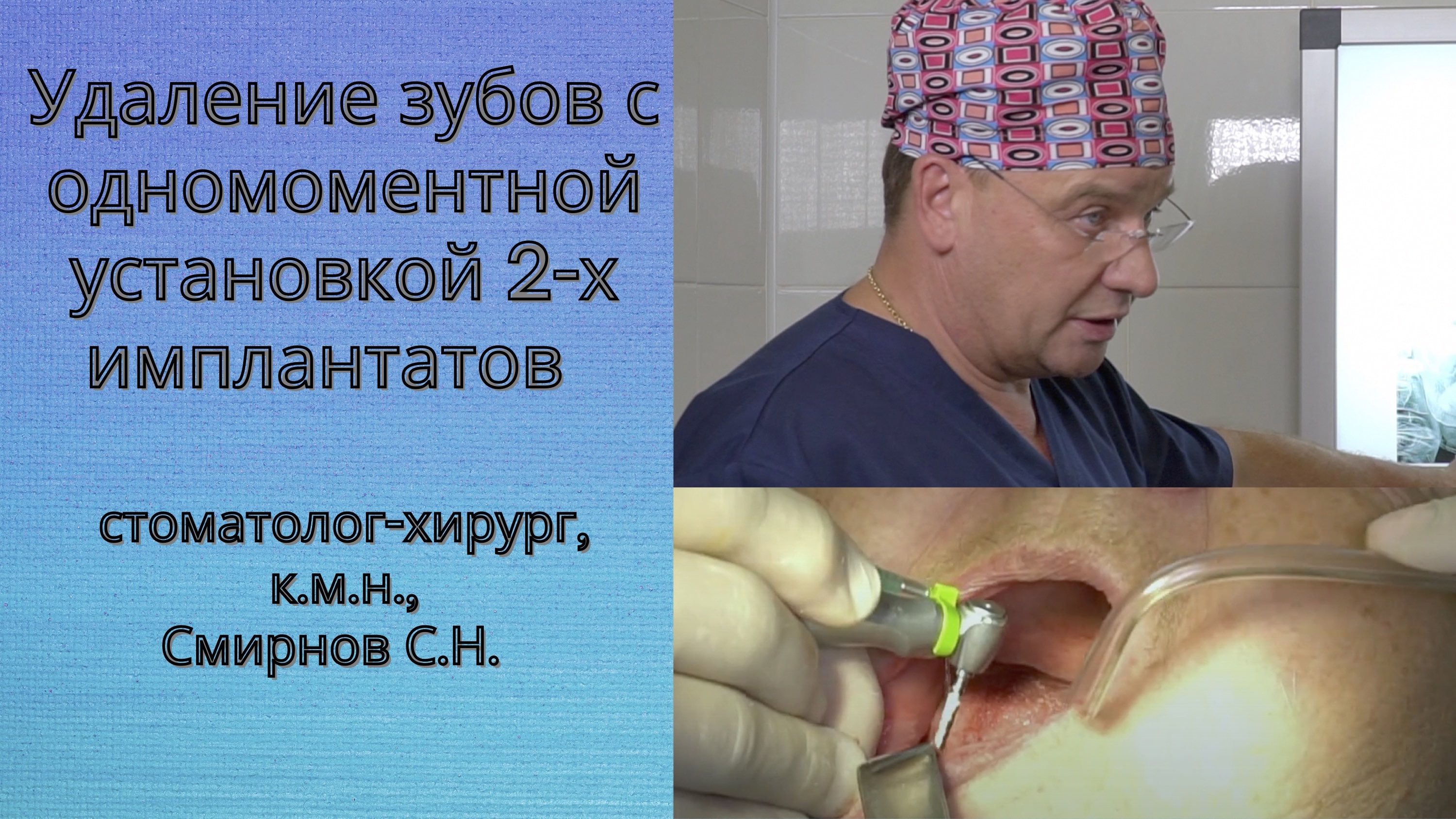 Установка двух имплантатов при полной адентии.