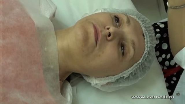 пилинги и микронидлинг   отличное средство против стрий