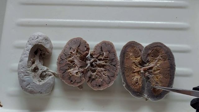 Почки, мочеточники, мочевой пузырь