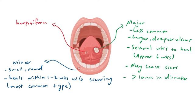 Understanding Recurrent Aphthous Stomatitis (RAS) or Oral Aphthous Ulcers