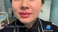 Коррекция губ филером на основе гиалуроновой кислоты