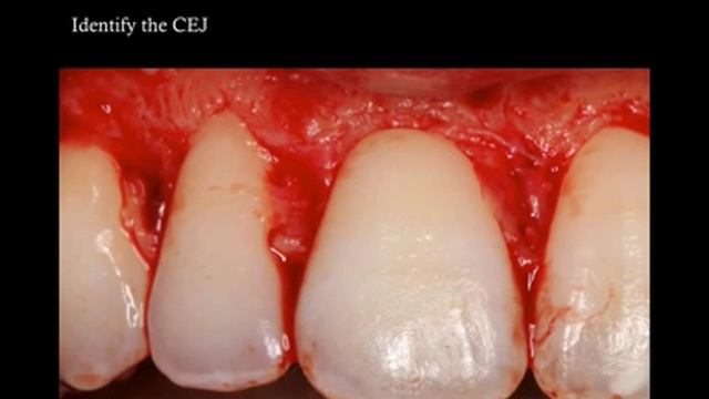 How to improve the smile with esthetic crown lengthening? (PART 3 of 3, SurgicalMaster QuickLecture