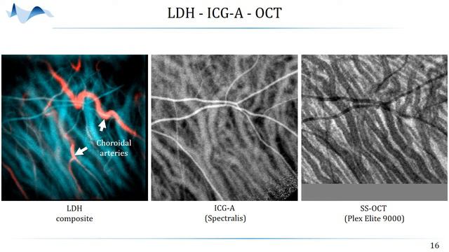 II - Choroidal vasculature imaging with laser Doppler holography