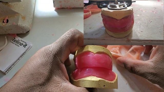 Denture Steps (Bite Blocks and Bite Registration)