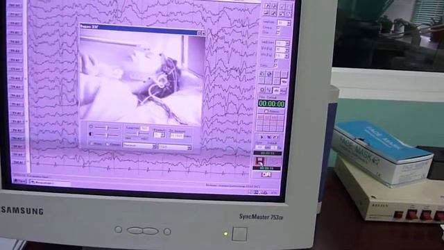 ЭЭГ видео мониторинг
