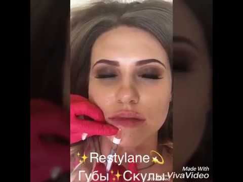 Рестилайн. Коррекция формы скул. Коррекция формы губ Москва.
