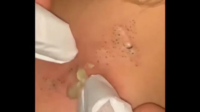 Big blackheads залипательное видео 2022 черные точки давим