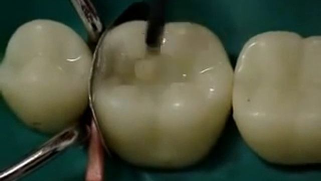 Реставрация моляра.flv