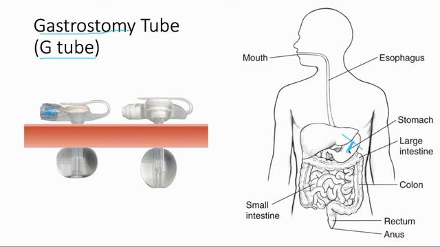 Surgical Tubes and Enteral Nutrition