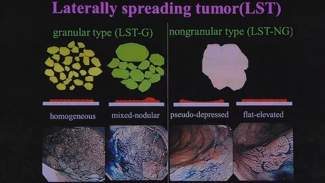 07 Hiroshi Kashida MD PhD Endoscopic diagnosis of colorectal non polypoid lesions