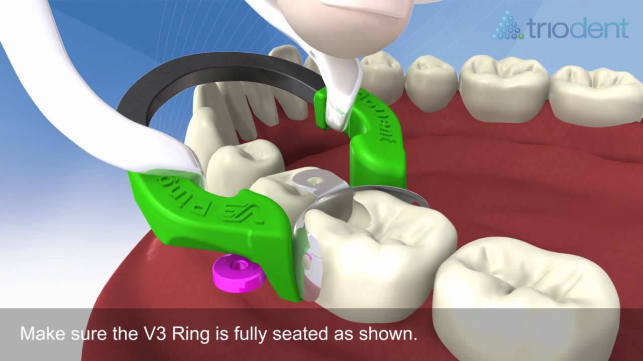 Triodent V3-ring Matrix.wmv