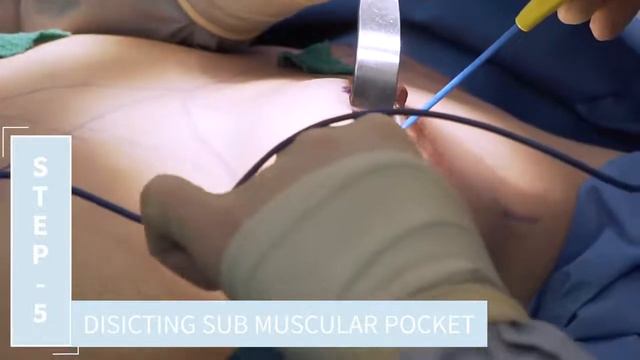 Breast Augmentation Procedure Breakdown featuring Beverly Hills Plastic Surgeon Dr  Daniel Barrett