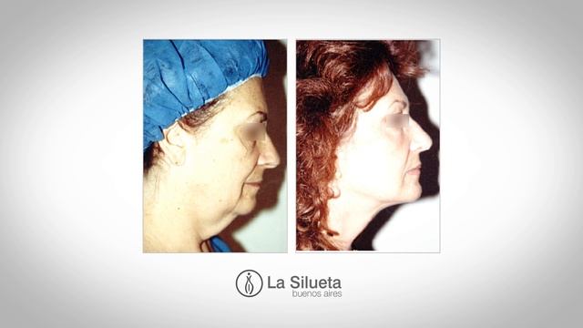 Vertical SMAS Lift