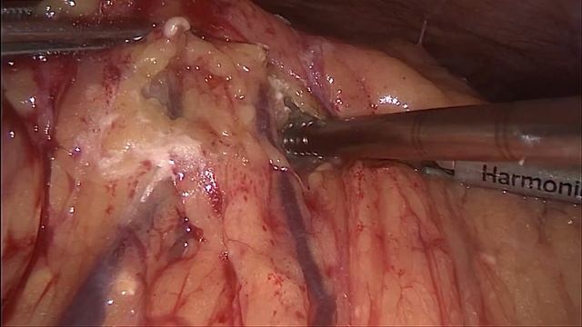 , #pancreonecrosis, #surgery, #laparoscopic,  #панкреонекроз