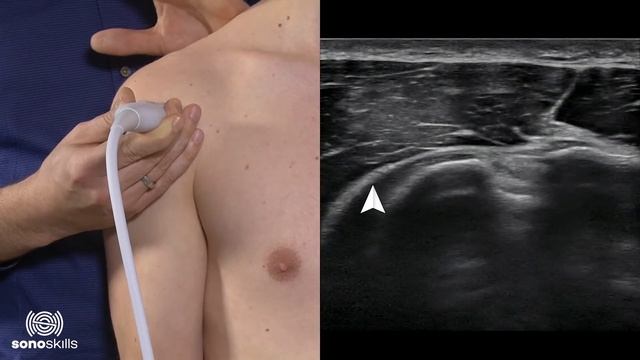 Ultrasound of the shoulder: Long head biceps tendon (transverse)
