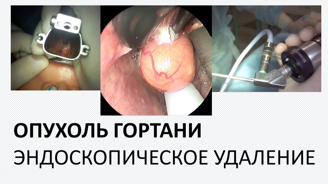 УДАЛЕНИЕ НОВООБРАЗОВАНИЯ ГЛОТКИ, КИСТА НАДГОРТАННИКА ЛОР ОПЕРАЦИЯ НА ГОРТАНИ ПОД НАРКОЗОМ     МОСКВА