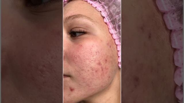 Лазерная шлифовка лица в Санкт-Петербурге