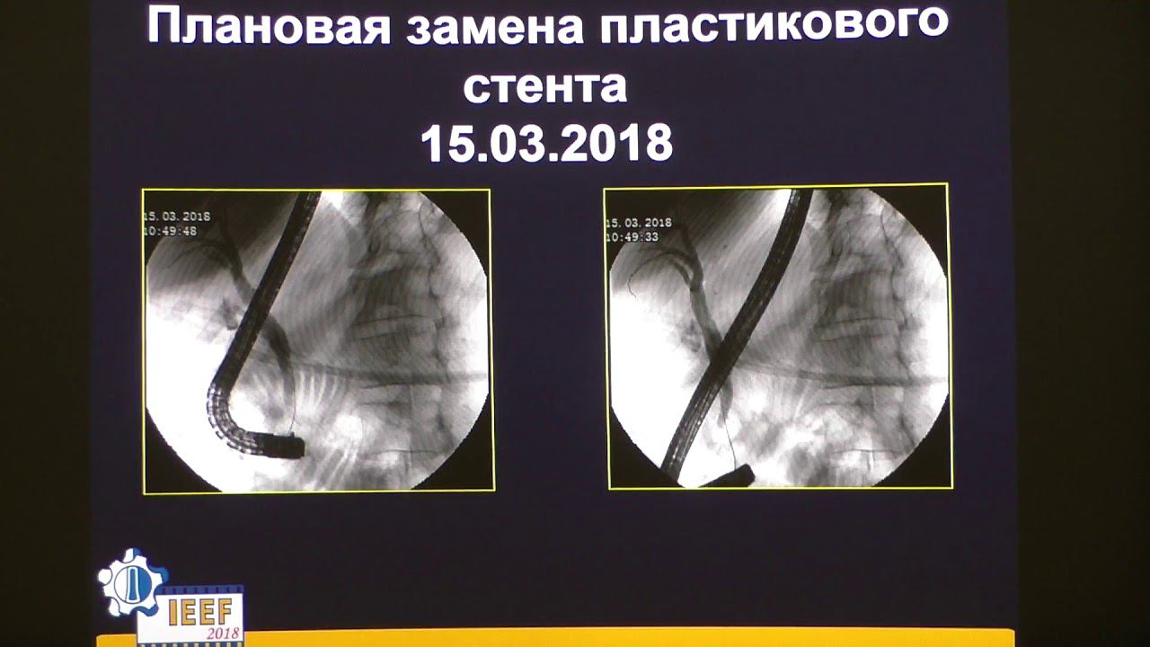 31КС Юричев ИН Лимфома поджелудочной железы эндоскопическая диагностика и лечение